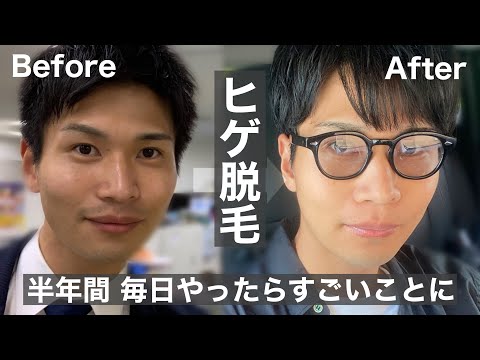 【メンズ】ヒゲ脱毛 半年間自宅でヒゲ脱毛した結果がすごかった