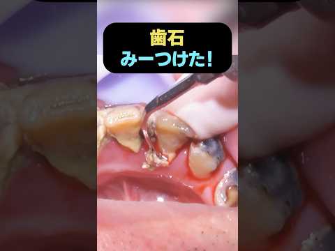 見つかっちゃった…😭 #歯医者  #dentist #奥歯　#歯石除去 #歯石 #tartar #ショート #shorts #あの花  #アニメ #anime