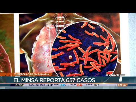 Minsa: Panamá reporta 657 casos de tuberculosis