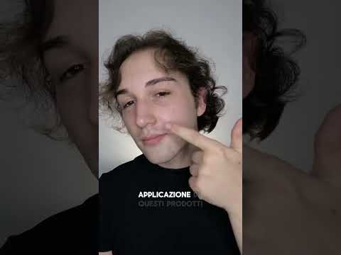 Acne: risultati prima e dopo Jacopo