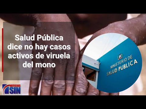 Salud Pública dice no hay casos activos de viruela del mono