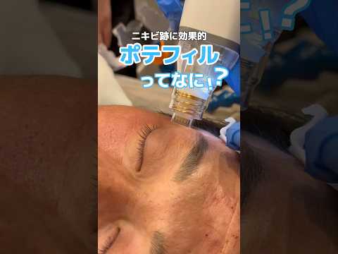 ニキビ跡にはこれして！！ #ニキビ跡 #クレーター #全身麻酔 #ポテンツァ #shorts
