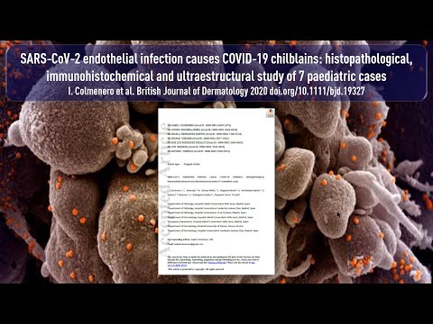 SARS-CoV-2: Infektion des Endothels erklärt „COVID-Zehen“