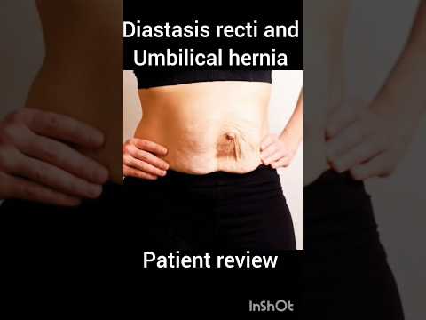 Diastasis Recti repair story: Arogya physiotips #diastasisrecti #diastasisrectirecovery