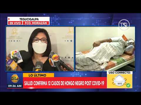 Salud confirma que ya son 12 casos de hongo negro post covid en Honduras