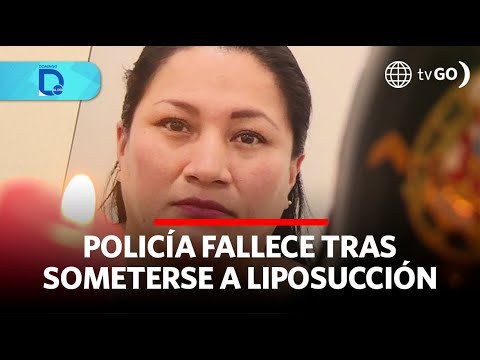 Policía fallece tras someterse a liposucción | Domingo al Día | Perú