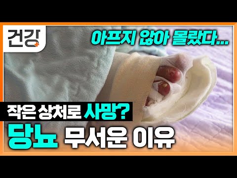 아프지 않아 몰랐던 작은 상처로 사망까지? 상처 하나도 무서운 당뇨 | 당뇨가 무서운 이유 | 명의 | #EBS건강