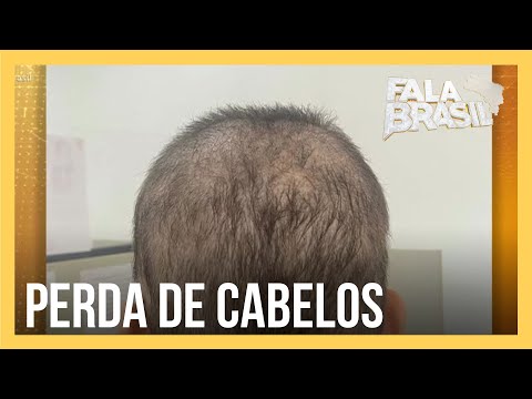 Alopecia areata: saiba quais são os cuidados e tratamentos