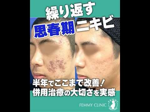 ⚠️思春期ニキビ、実は深刻… ⚠️