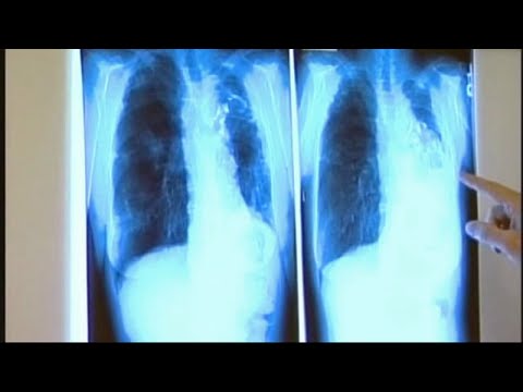 Long Beach tuberculosis outbreak: 1 killed, 14 infected, 170 exposed