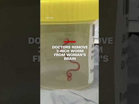 Worm removed from woman's brain
