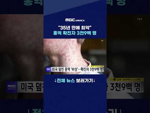 “35년 만에 최악”…홍역 확진자 3천9백 명