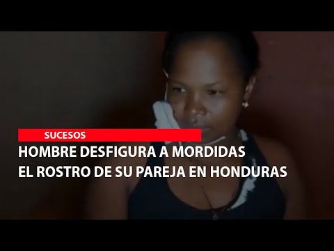 Hombre desfigura a mordidas el rostro de su pareja en Honduras
