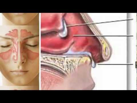 Nasal Polyps Natural Treatment Tea Tree Oil Nasal Polyps Natural Treatment Tea Tree Oil