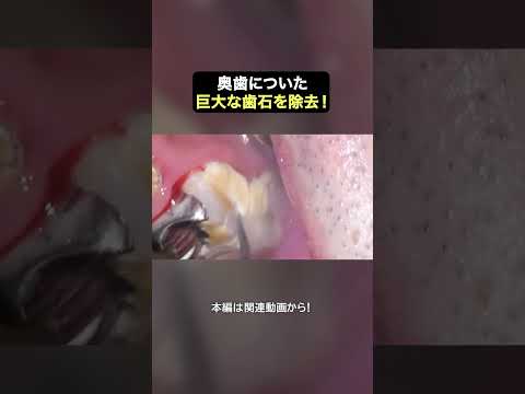 歯を覆い隠すほどの巨大な歯石を除去!