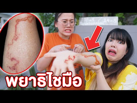 ระวัง-พยาธิเข้าผิวหนัง-อาจต้อง ระวัง-พยาธิเข้าผิวหนัง-อาจต้อง