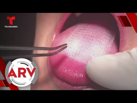 Coser mallas en la lengua para adelgazar podría ser dañino | Al Rojo Vivo | Telemundo