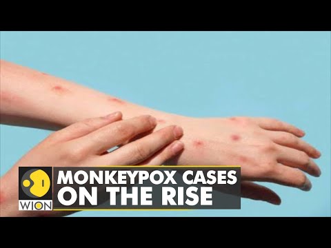 🌎Monkeypox cases on the rise: What are the key symptoms of infection? | World News | WION