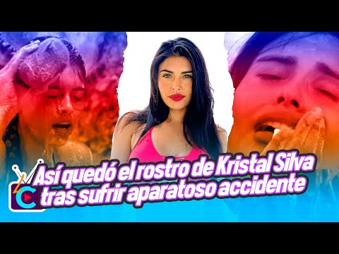 Survivor México: Así quedó el rostro de Kristal Silva tras sufrir aparatoso accidente