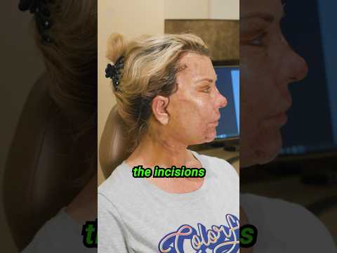 5 Days Post-Op | Deep Plane Face & Neck Lift #cosmeticsurgery #face #antiaging