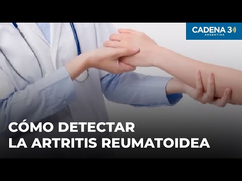 Artritis reumatoidea: importancia de la detección temprana para su tratamiento | Cadena 3