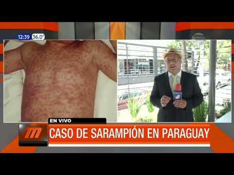 Salud confirma caso de sarampión en Paraguay