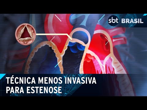 SUS oferece técnica menos invasiva para o tratamento de estenose aórtica | SBT Brasil (17/04/24)