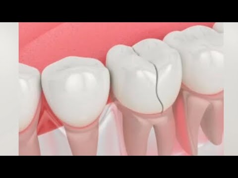 ¿Qué son las fracturas dentales?