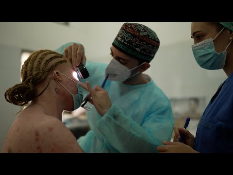 Dermatólogos internacionales ayudan a tratar el cáncer de piel de albinos en Mozambique