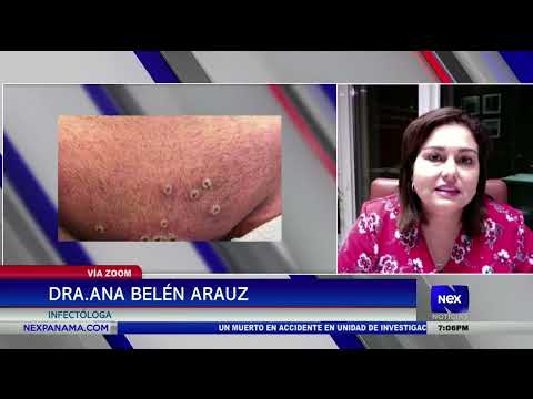 Entrevista a Dra. Ana Belén Arauz, infectologa y la viruela del mono