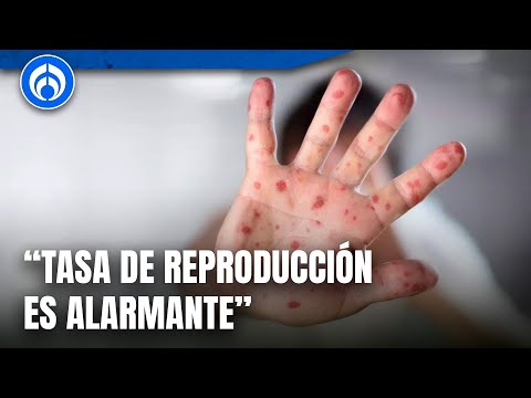 Secretaría de Salud lanza alerta epidemiológica por casos de sarampión