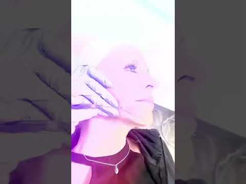 Full face filler transformation!