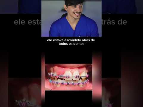 Aparelho faz Mágica nos dentes. Assista até o fim! #shorts