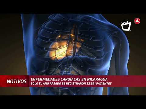 5,159 personas murieron por infarto agudo de miocardio en Nicaragua, en el 2022.