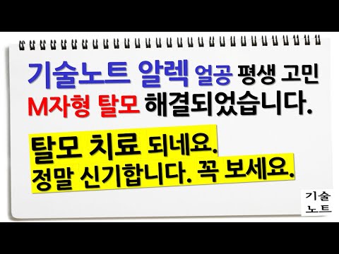 탈모 치료 하는 곳 (제가 경험한 것 그대로 말씀드리고, 본문 링크로 실제 다른 분 사례 영상도 있습니다.)