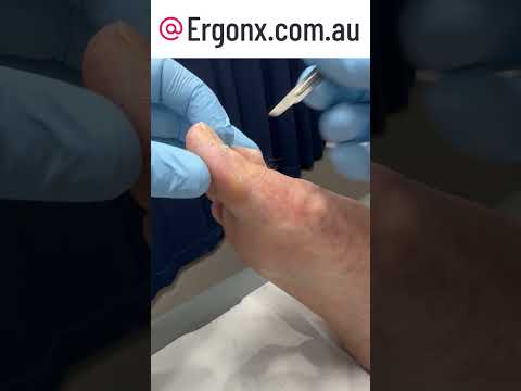 Satisfying Big Toe Callus Removal by Expert Podiatrist #FootCare #SatisfyingVideos
