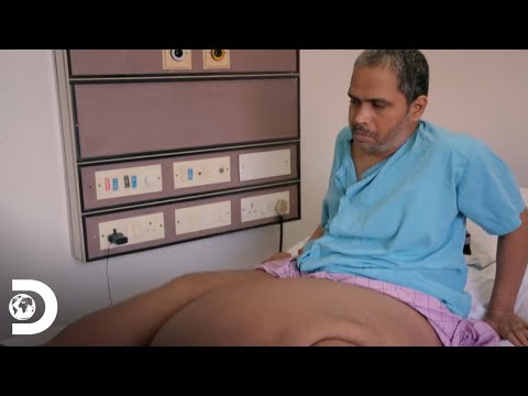 Un hombre padece un enorme tumor de 14 kilogramos en el muslo | Mi Cuerpo, Mi Desafío | Discovery