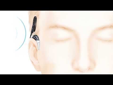 Wie funktioniert ein Cochlea-Implantat?
