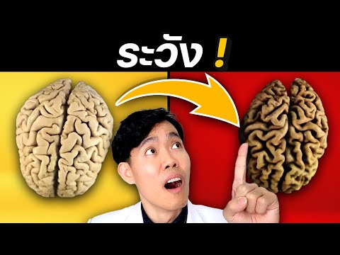 5อาหารเร่งอัลไซเมอร์สมองเสื