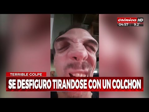 Se tiró por un tobogán... ¡y se desfguró el rostro!