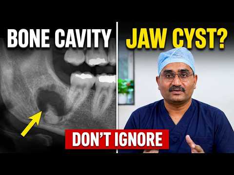 Jaw Cyst Symptoms & Treatment: Don't Ignore This Bone Cavity!
