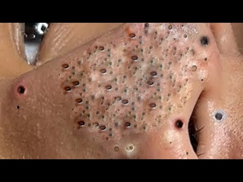 BigCysticAcneBlackheadsExt