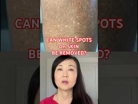 Can White Spots on the Skin Be Removed #whitespots #goseechristy