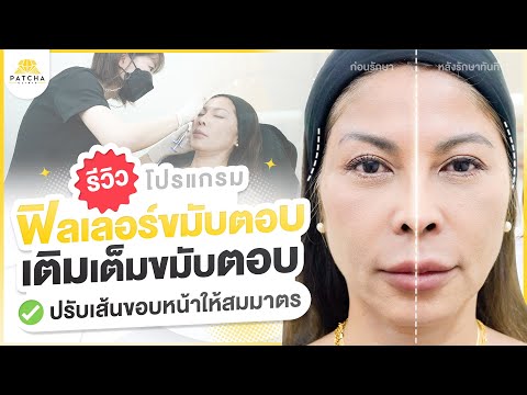 รีวิวฟิลเลอร์ขมับตอบเติมเต็มข