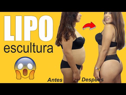 Mira AQUÍ los RESULTADOS caso real  LIPOESCULTURA de IMPACTO ? Dr PERCY NEVADO Cirugía Plástica