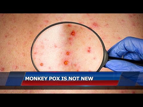 Monkey Pox Not New