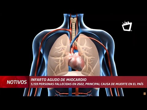 5,159 nicaragüenses murieron en 2022 por infartos agudos de miocardio