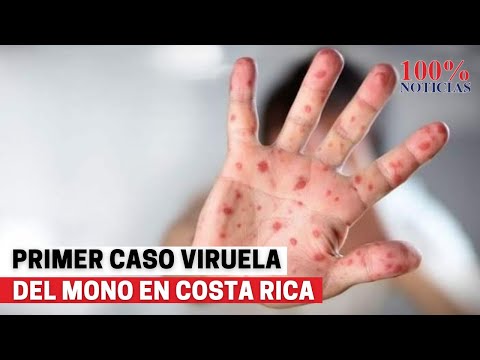 #LoÚltimo Costa Rica detecta el primer caso de la Viruela del mono
