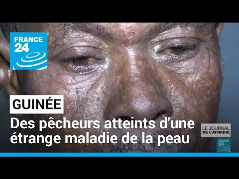 En Guinée, des pêcheurs atteints d'une étrange maladie de la peau • FRANCE 24