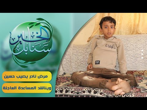 حالة إنسانية | الطفل حسين ومعاناته من تشوه خلقي | سنابل الخير